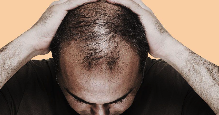 효과적이고 저렴한 탈모 솔루션 한국 최고의 탈모 억제제를 만나보세요